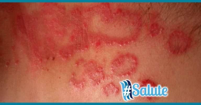 rash-356433_1920